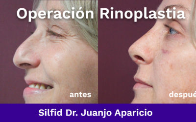 Rinoplastia. Operación en nuestro quirófano de Alicante